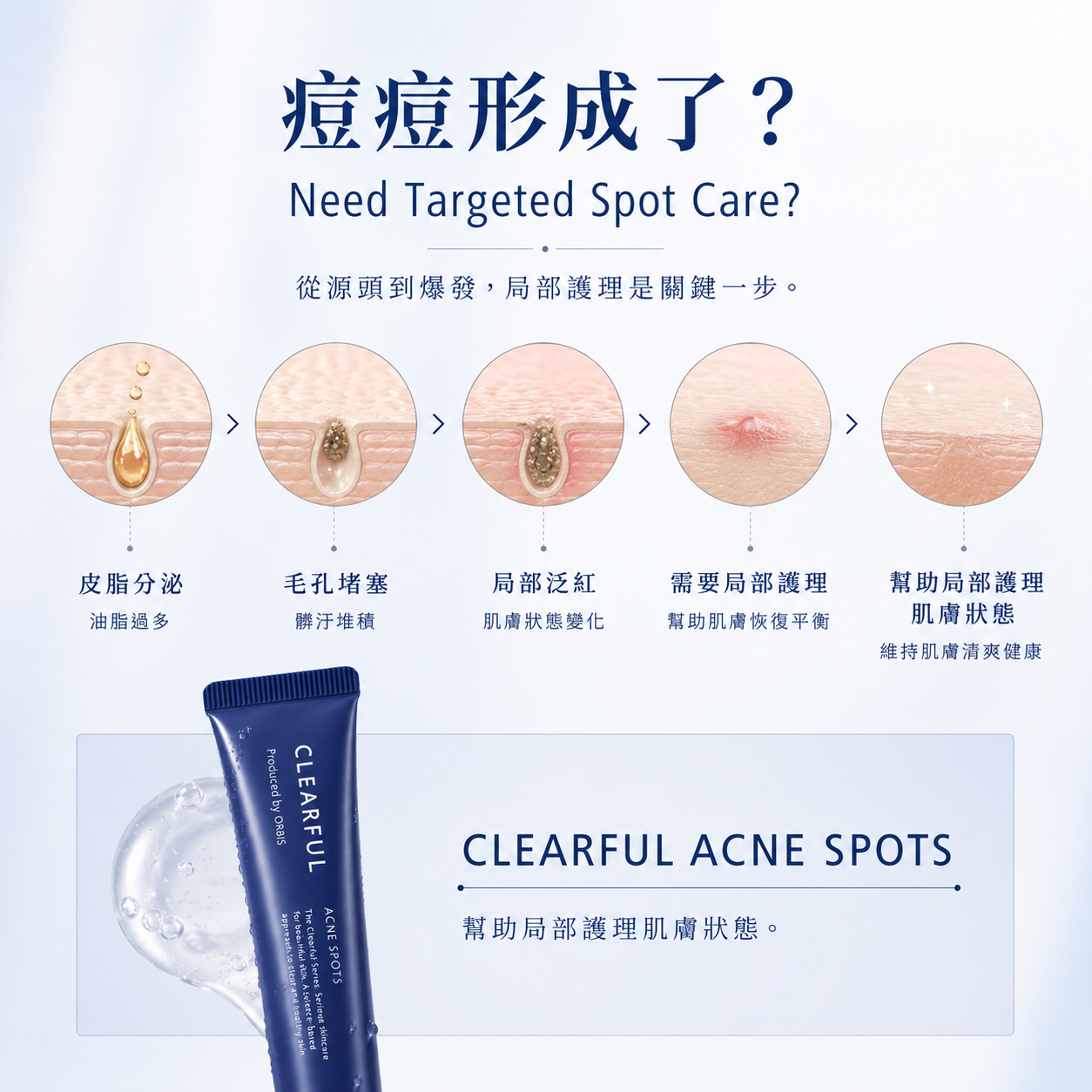 ORBIS CLEARFUL Acne Spots 痘痘局部护理凝胶 局部护理说明